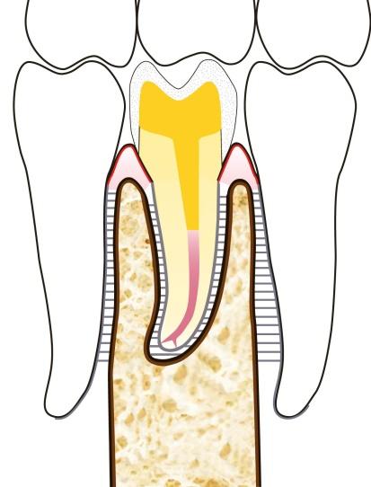Sinistra: il dente è fratturato/cariato sottogengiva. Centro: il dente fratturato/cariato è stato devitalizzato. Destra: nel dente è stato cementato un perno d oro e una corona provvisoria in resina.