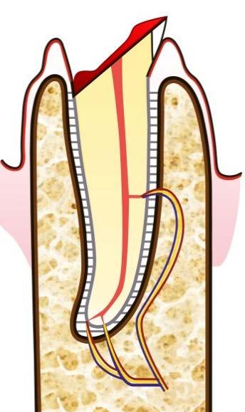 Come si esegue la tecnica del recupero chirurgico di un dente fratturato sottogengiva /