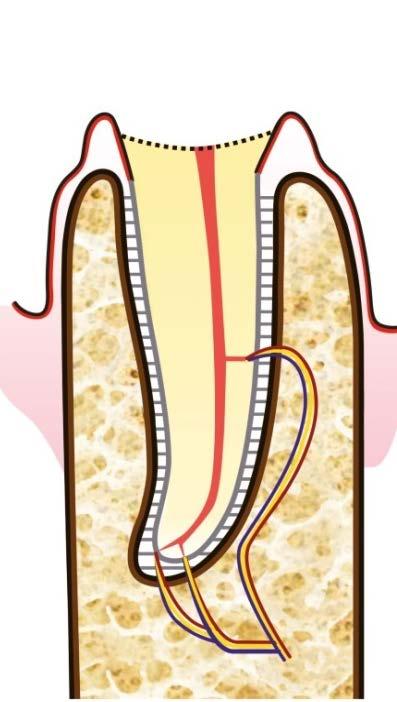 Sinistra: dente cariato sotto gengiva.