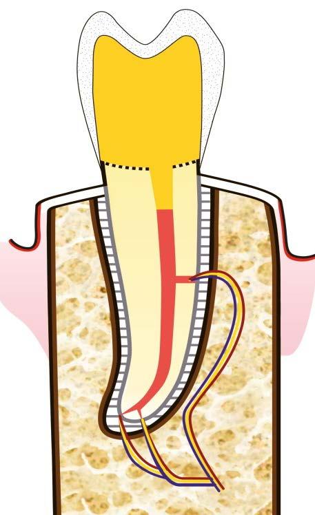 circonda il dente a mò di ferula, per evitarne un ulteriore frattura).