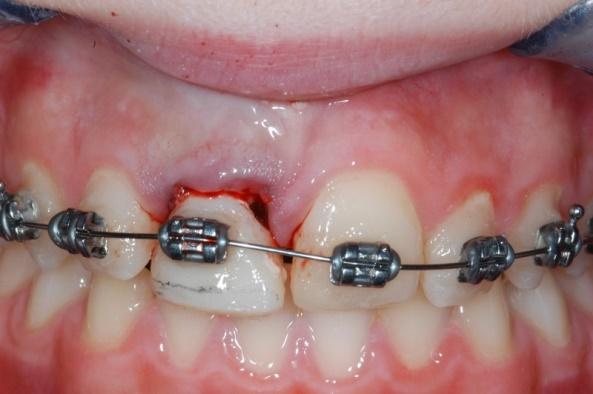 Cementato un dente provvisorio sul perno d oro, per 12 mesi è stata applicata una apparecchiatura ortodontica, per potere lentamente fare uscire la