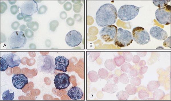 Leucemia mieloide acuta (A, B) LAM M2, Sudan B