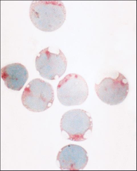 Leucemia