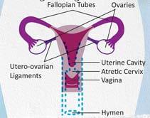 Patologia ostruttiva tratto genitale inferiore Atresia disgenesia cervicale Valutazione quantità di tessuto cervicale presente ; presenza