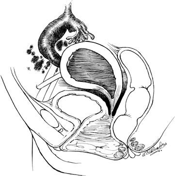 Patologia ostruttiva tratto genitale inferiore Atresia disgenesia cervicale Disgenesia cervice in associazione a Atresia vaginale + normale morfologia e funzione utero Ematometra, emato salpinge