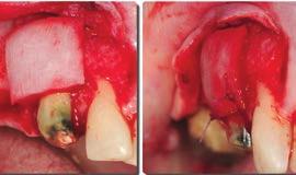 trattamento delle recessioni sugli elementi dentali naturali La chirurgia muco-gengivale resettiva per migliorare l estetica del sorriso Le tecniche di prelievo di innesti connettivali o