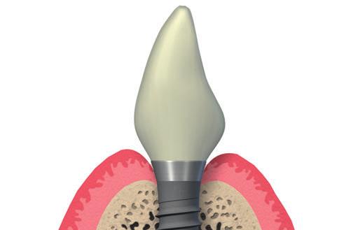 Più di una filosofia implantare. Un trattamento più semplice. Gestire la complessità nel vostro studio dentistico è fondamentale per lavorare sui pazienti con assoluta tranquillità.