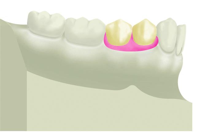 mascherina di pianificazione, si esegue la presa d impronta delle condizioni anatomiche del cavo orale e si procede alla realizzazione del modello master.