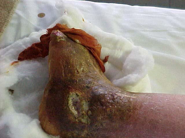 Ulcera infetta (infezione profonda) Esame clinico Esame colturale