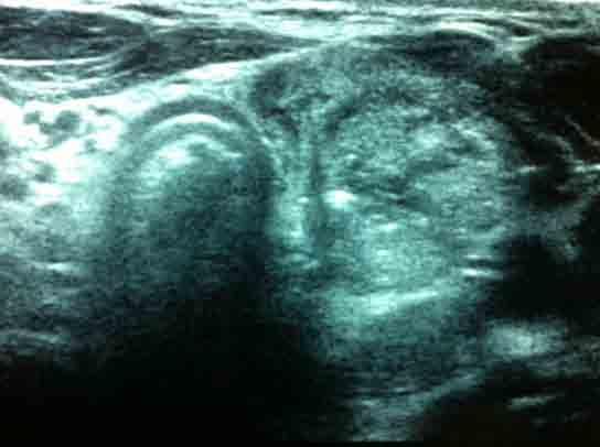 indicazioni della tiroidectomia con diametro dei noduli non