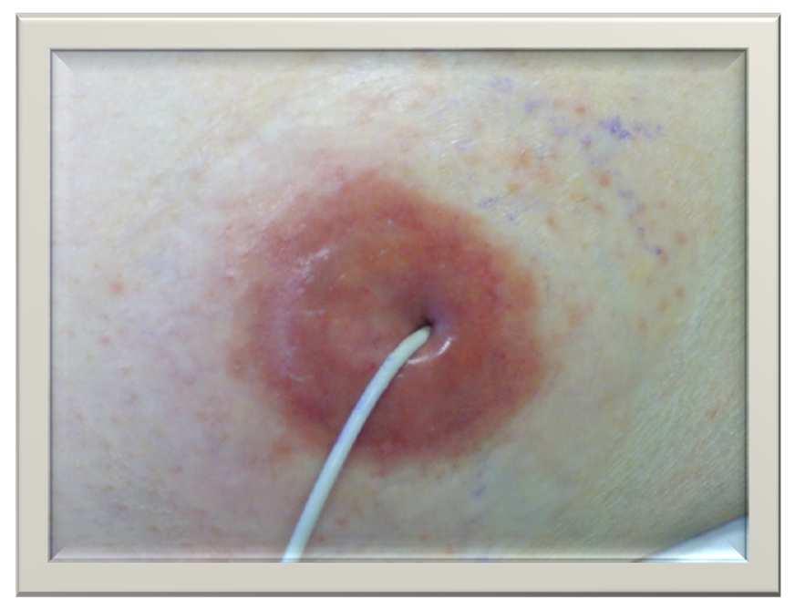 L1 Lesione iperemica (arrossamento