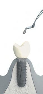 Ricostruzione provvisoria con cappetta multifunzione isy (PEEK) Per una ricostruzione immediata di denti singoli, che sia provvisoria ma al tempo stesso estetica, si può utilizzare la cappetta