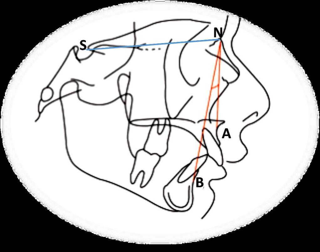 ! Figura 3: Esempio di tracciato cefalometrico dove sono presenti i punti S (Sella), N