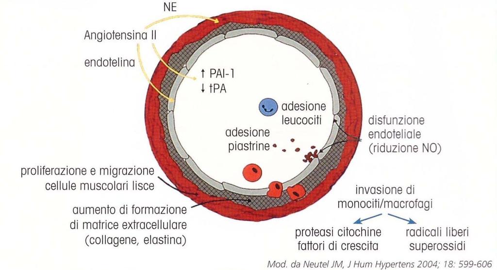 EFFETTI ATEROGENI DELL ANGIOTENSINA II Ai noti effetti di vascocostrizione ed espansione di volume si affiancano amplificazione dei processi immunitari ed infiammatori a carico della parete vascolare