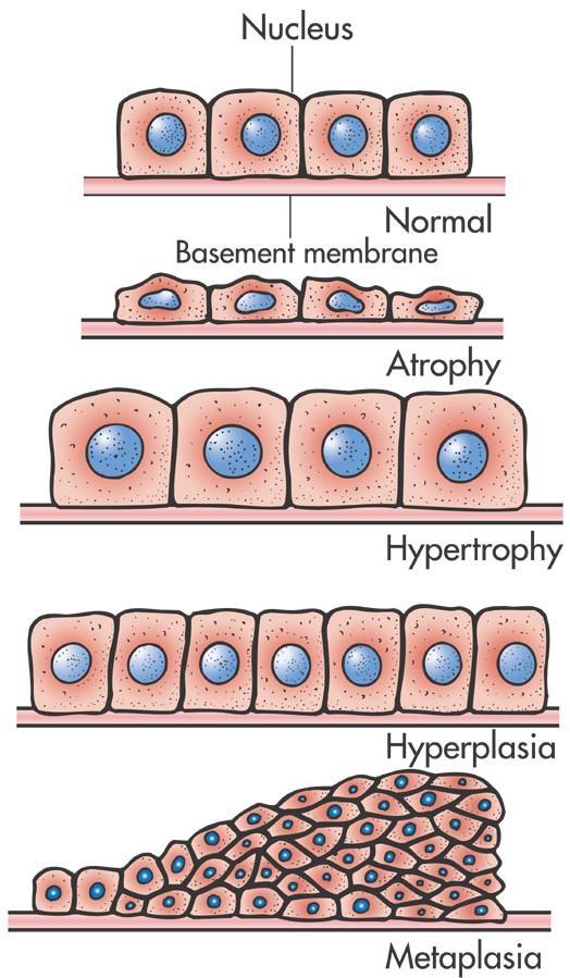 Atrofia: Modalità di adattamento Riduzione delle dimensioni delle cellule, dei tessuti o degli organi.