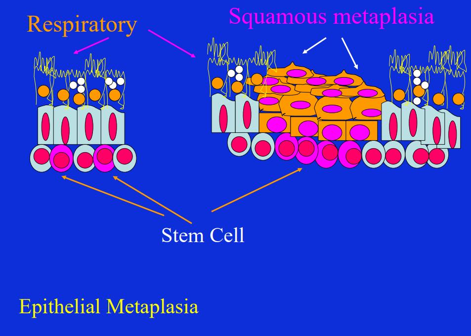 La metaplasia non deriva da cambiamento fenotipico di un tipo cellulare differenziato ma è il risultato di riprogrammazione di cellule staminali (progenitrici) presenti nei tessuti