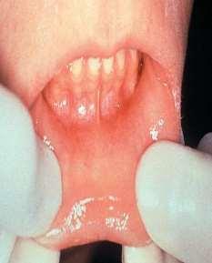 Oral Mucositis: WHO