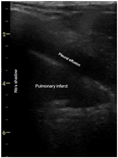 ECOGRAFIA & PE Venous US (CUS) Echocardiography RH strain RV/LV ratio Abnormal/paradoxical septal motion RH strain curve