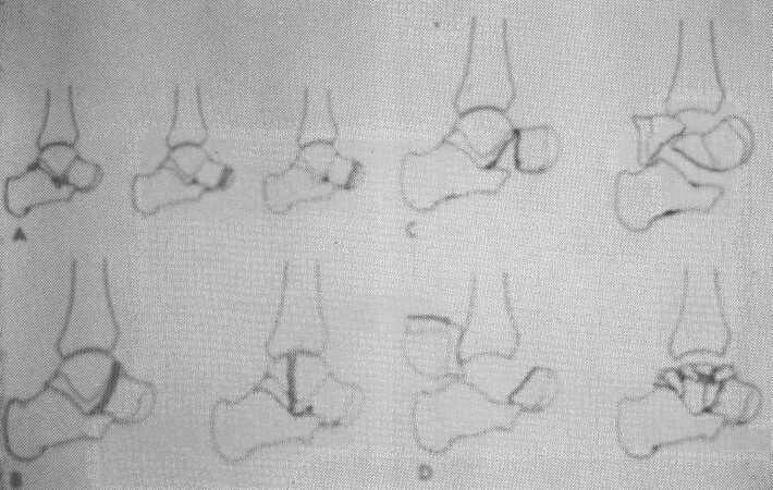 G. CASCIA, E. LANZARA, A. ROSITO dall'arteria pedidia; dall'arteria tibiale posteriore; 22 accessori dall'arteria peroneale posteriore.