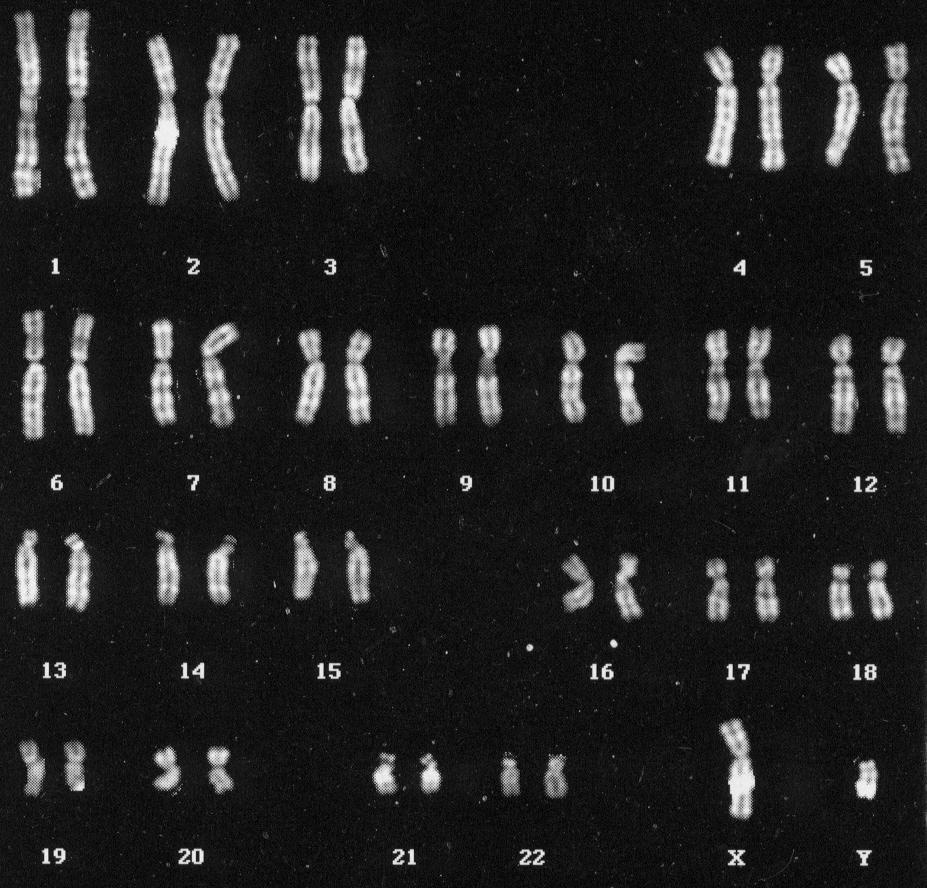 Cromosomi metafase 2 metri cariotipo umano Maschile: 44 autosomi + XY
