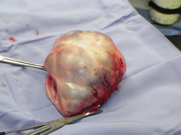 Ovariectomia destra con asportazione completa della massa conservando la