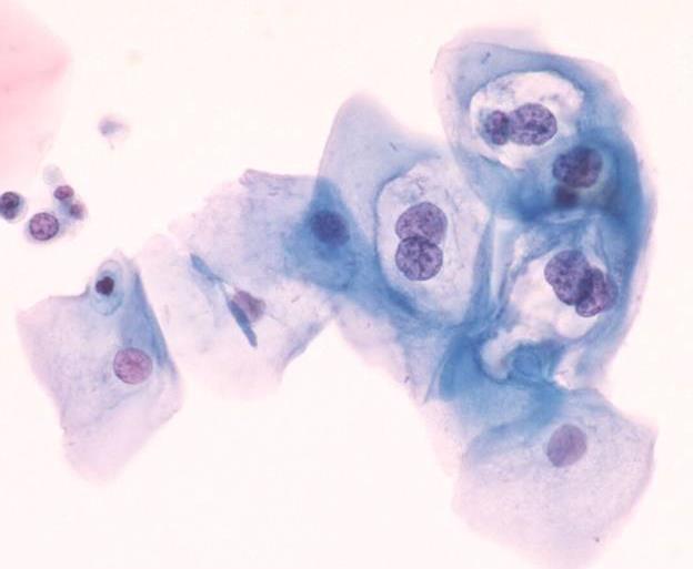 INFEZIONE PRODUTTIVA Morte cellulare LSIL L1-L2 L1-L2-E4 E1-E2-E5-E6-E7 E1-E2 E1-E2 RB E6-E7 P53 Inibitori della crescita sono bloccati in maniera transitoria Coiloctosi, maturazione rapida