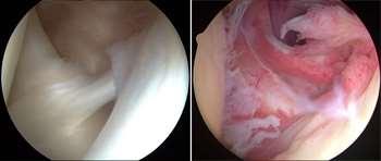 CAPSULITE ADESIVA Patologia infiammatoria della capsula articolare che causa perdita di mobilità.