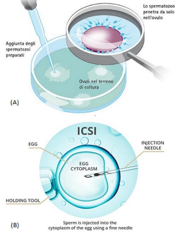 Le fasi dell ICSI 1. Controllo e stimolazione dell ovulazione.