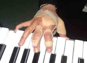 Case study Pianista professionista, anni 42 Distonia focale alle dita della mano destra (insorgenza sul 2 dito, poi coinvolgimento del 1 e 3 ) Trattamento