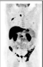 Tomografia ad emissione di positroni (PET) con radiofarmaci oncotropi Nella fase di ristadiazione: Evidenze scientifiche dimostrano che la 11C/18F colina PET/CT è indicata nel cancro della prostata