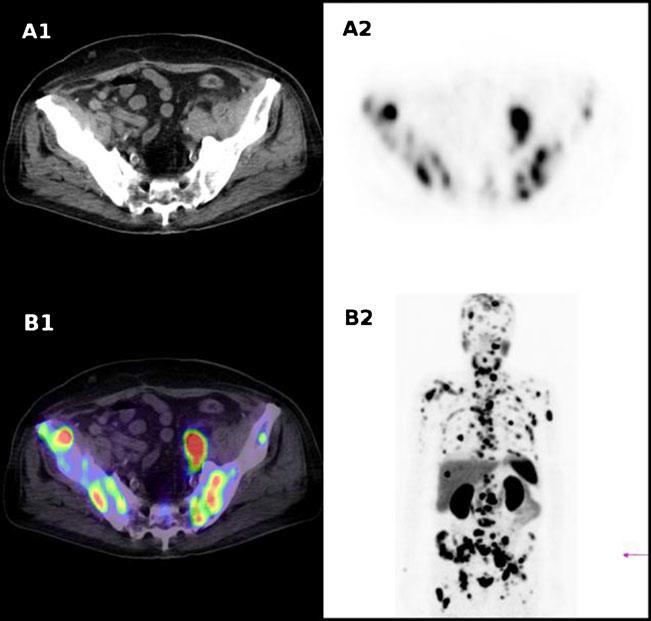 Tomografia ad emissione di positroni (PET) con radiofarmaci oncotropi (con 68 Ga-PSMA) La PET/CT con 68 Ga-PSMA (Prostate Specific Membrana Antigen), è tuttora una indagine sperimentale, anche se