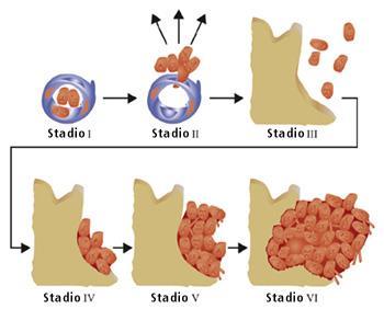 Scheletro sede preferenziale di secondarismi prostatici Formazione delle metastasi ossee: cascata di eventi Le cellule tumorali si staccano dal tumore allo stadio precoce.