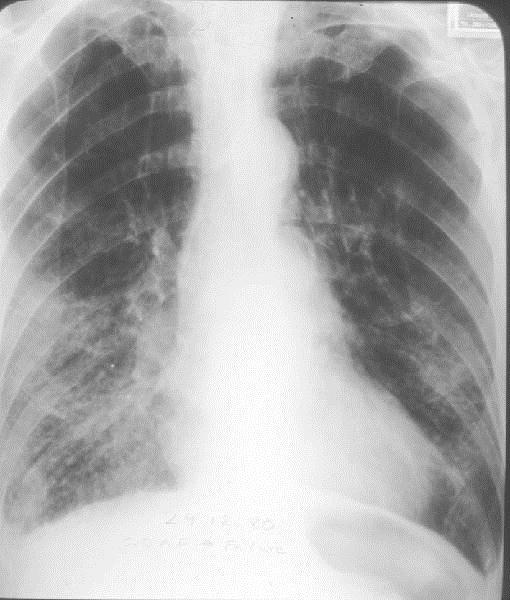 Nella radiografia standard la BPCO puo mascherare o simulare la CHF L iperinflazione riduce il rapporto cardiotoracico Il rimodellamento vascolare e l iperdiafania polmonare mascherano gli