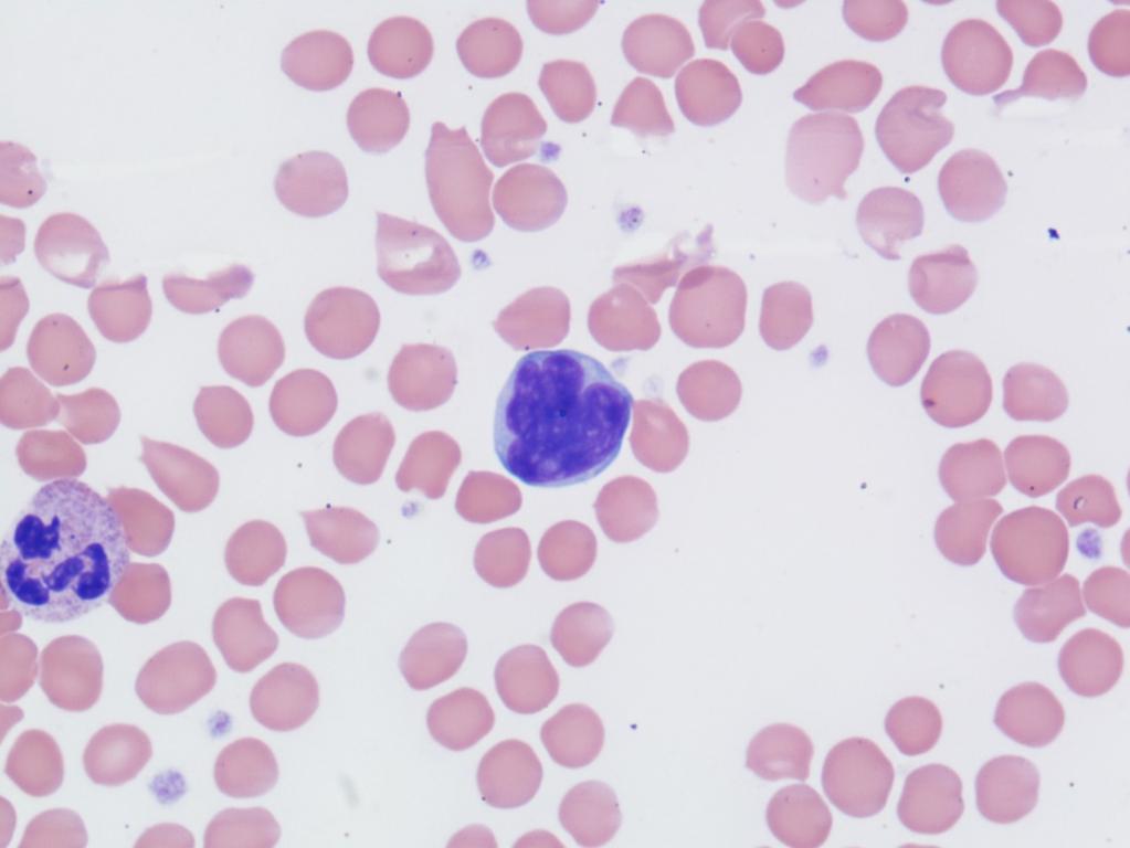 Abb.6 La combinazione con l eosinofilia fa nascere il sospetto, che si possa trattare di un linfoma a cellule T; i nuclei dalla configurazione anomala fanno presumere una sindrome di Sezary.