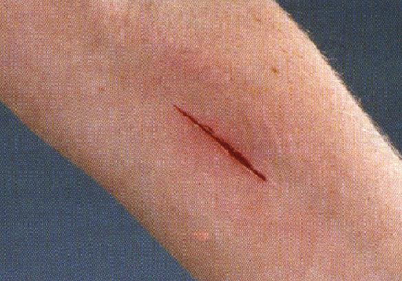 Ferita da taglio lesione nella quale i margini della cute ed i tessuti sottostanti sono