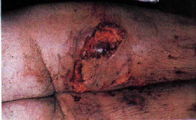 Ferita lacero contusa I tessuti sono strappati e la ferita presenta dei margini irregolari.