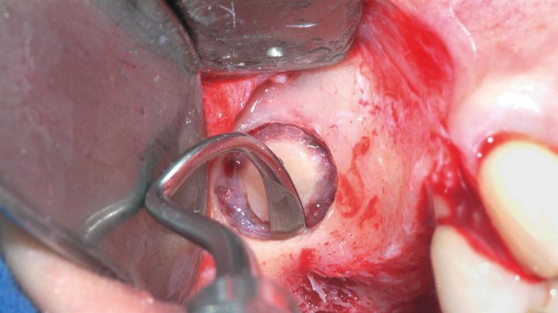 Indicazioni Cliniche S3 Rialzo del seno mascellare Concetto di trattamento del Dr.