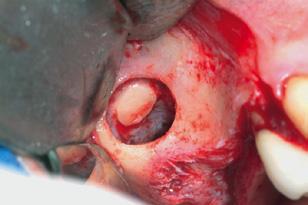 Fig. 4 Sollevamento del lembo mucoperiostale dopo le incisioni di rilascio mesiali.
