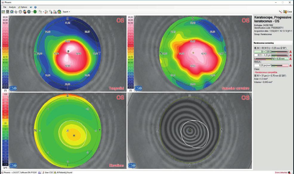 FRONTE D ONDA OCULARE Il software a corredo consente di effettuare l