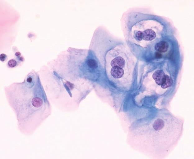 INFEZIONE PRODUTTIVA Morte cellulare LSIL L1-L2 L1-L2-E4 E1-E2-E5-E6-E7 E1-E2 E1-E2 RB E6-E7 P53 Inibitori della crescita sono bloccati in maniera transitoria Coiloctosi, maturazione rapida Infezione