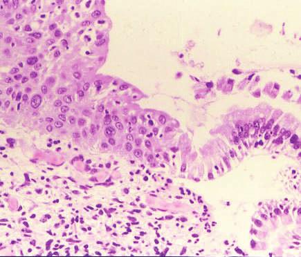 Metaplasia squamosa in colposcopia Zona di trasformazione La replicazione dell dipende dalla replicazione e differenziazione delle cellule ospiti di cui il virus