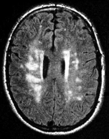 ENCEFALITE DA HIV