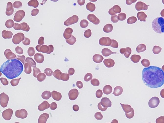 L emocromo del paziente di 54 anni mostrava un anemia normocitica e normocromica pronunciata (Hb 8.3g/dl) e una trombocitopenia (104 G/L).