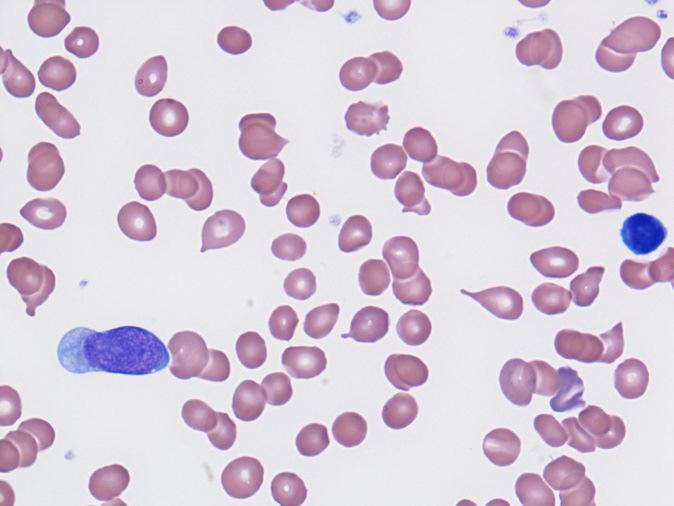 4) e un dilavamento di eritroblasti (ca. 5/100 leucociti; fig. 5).