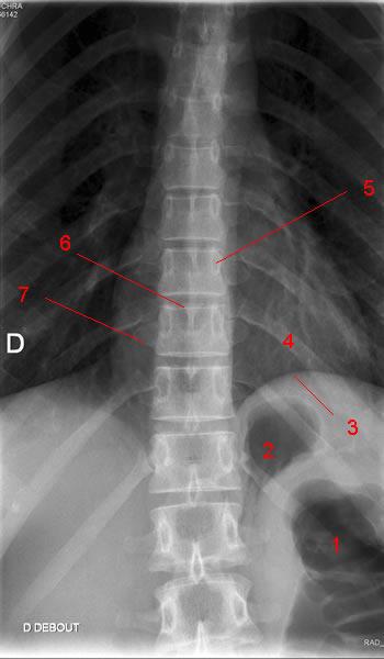 3 2.ANATOMIA RADIOLOGICA 1. Gas a Colon (flessura splenica) 2.