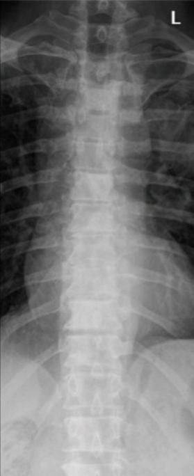 CENTRATURA E DIREZIONE RAGGIO= raggio incidente perpendicolare al detettore, centrato sul margine inferiore del manubrio sternale (indicativamente C7).