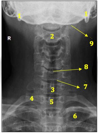 4 2. ANATOMIA RADIOLOGICA 1- Angoli mandibolari 2- Corpo di C3 3- Corpo di C7 4- Prima costa 5- Corpo di