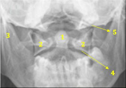 5 1- Dente dell epistrofeo 2- Masse laterali dell Atlante 3- Mandibola 4- Interlinea