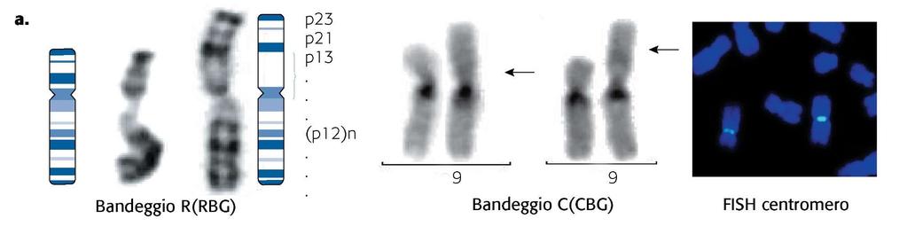 Polimorfismi dell eucromatina Sono denominati HSR (Homogeneously Staining Regions).