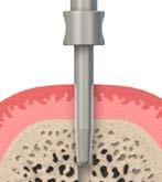 Inserire il moncone di parallelismo 2,2 mm per verificare il corretto allineamento dell asse implantare.
